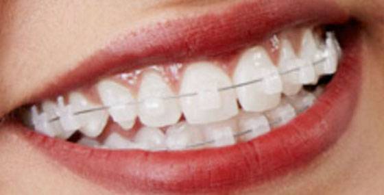 XM 6 pièces transparentes dentaires simple/Double tête t-forme Intraoral  joue lèvre écarteur orthodontique lèvre joue écarteur bouche ouvreurs
